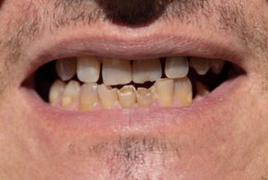 gum disease medication dental issues adelaide