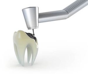 crown for cracked tooth solution adelaide