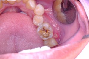 tooth abscess complications signs adelaide