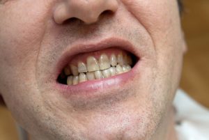 Amoxicillin for Tooth Abscess or tooth pain adelaide