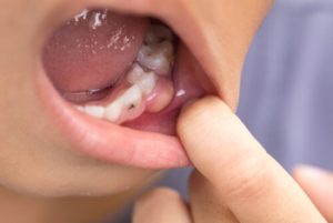 Can You Pull A Tooth With An Abscess swelling adelaide