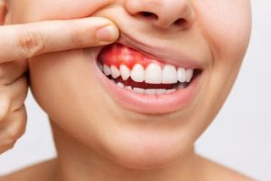 tooth abscess rupture drain adelaide