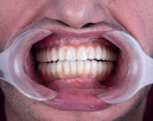 Dental Cellulitis Vs Abscess gums