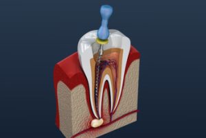 Dental Cellulitis Vs Abscess root canal procedure