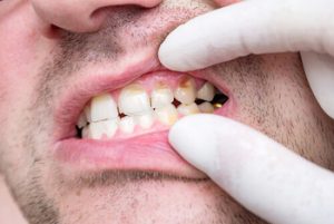 Types Of Dental Abscess swelling