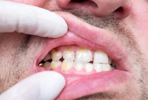 How Long Does A Tooth Abscess Last gums