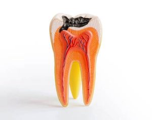 What Causes Teeth to Crack cavity