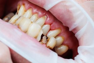 What Causes Teeth to Crack fracture