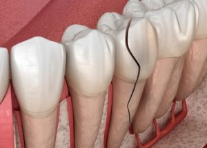 Are Cracks in Teeth Normal fracture