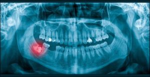 How Long Can a Broken Tooth Go Untreated infection