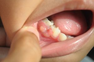 Is A Cracked Tooth An Emergency gum disease