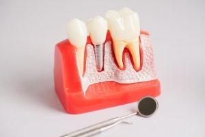 Infected Tooth Broken at Gum Line implant